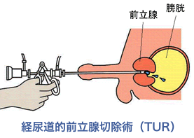 経尿道的前立腺切除術（TUR）